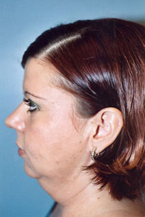 Facelift Before Photo by Kristoffer Ning Chang, MD; San Francisco, CA - Case 10403