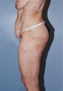Body Contouring Before Photo by Kristoffer Ning Chang, MD; San Francisco, CA - Case 10412