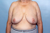 Breast Reduction After Photo by Kristoffer Ning Chang, MD; San Francisco, CA - Case 10418