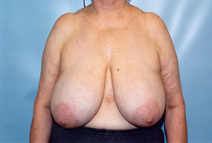 Breast Reduction Before Photo by Kristoffer Ning Chang, MD; San Francisco, CA - Case 10418