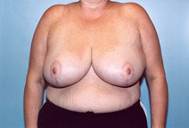 Breast Reduction After Photo by Kristoffer Ning Chang, MD; San Francisco, CA - Case 10419
