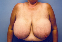 Breast Reduction Before Photo by Kristoffer Ning Chang, MD; San Francisco, CA - Case 10419
