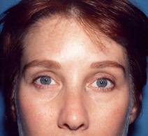 Facelift After Photo by Kristoffer Ning Chang, MD; San Francisco, CA - Case 10433