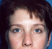Facelift Before Photo by Kristoffer Ning Chang, MD; San Francisco, CA - Case 10433