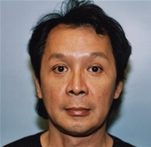 Facelift Before Photo by Kristoffer Ning Chang, MD; San Francisco, CA - Case 20006