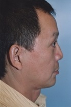 Facelift After Photo by Kristoffer Ning Chang, MD; San Francisco, CA - Case 20006