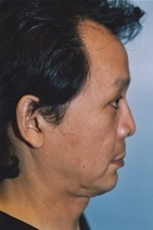Facelift Before Photo by Kristoffer Ning Chang, MD; San Francisco, CA - Case 20006