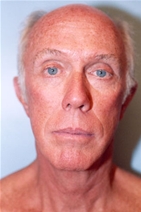 Facelift After Photo by Kristoffer Ning Chang, MD; San Francisco, CA - Case 20008