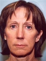 Facelift After Photo by Kristoffer Ning Chang, MD; San Francisco, CA - Case 20017