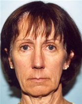 Facelift Before Photo by Kristoffer Ning Chang, MD; San Francisco, CA - Case 20017