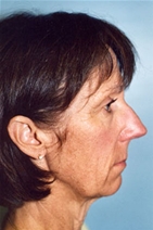 Facelift Before Photo by Kristoffer Ning Chang, MD; San Francisco, CA - Case 20017