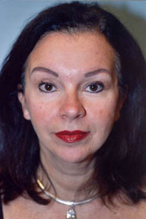 Facelift After Photo by Kristoffer Ning Chang, MD; San Francisco, CA - Case 20019
