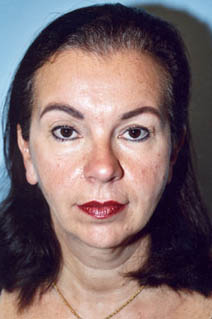 Facelift Before Photo by Kristoffer Ning Chang, MD; San Francisco, CA - Case 20019