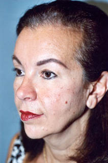 Facelift Before Photo by Kristoffer Ning Chang, MD; San Francisco, CA - Case 20019