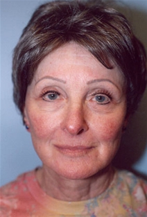 Facelift After Photo by Kristoffer Ning Chang, MD; San Francisco, CA - Case 20441