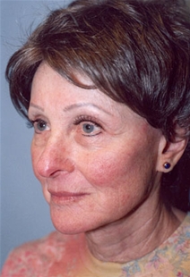Facelift After Photo by Kristoffer Ning Chang, MD; San Francisco, CA - Case 20441