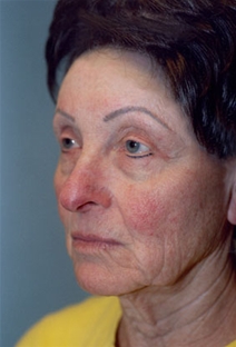 Facelift Before Photo by Kristoffer Ning Chang, MD; San Francisco, CA - Case 20441