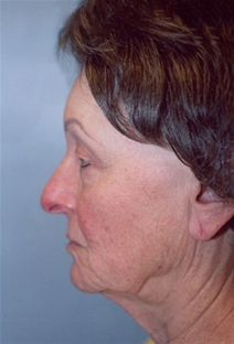 Facelift Before Photo by Kristoffer Ning Chang, MD; San Francisco, CA - Case 20441