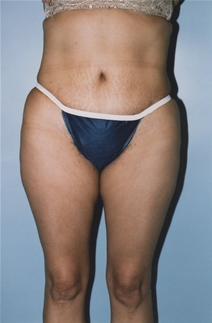 Tummy Tuck After Photo by Kristoffer Ning Chang, MD; San Francisco, CA - Case 20536