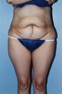 Tummy Tuck Before Photo by Kristoffer Ning Chang, MD; San Francisco, CA - Case 20536