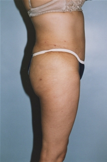 Tummy Tuck After Photo by Kristoffer Ning Chang, MD; San Francisco, CA - Case 20536