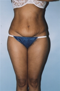 Tummy Tuck Before Photo by Kristoffer Ning Chang, MD; San Francisco, CA - Case 20537