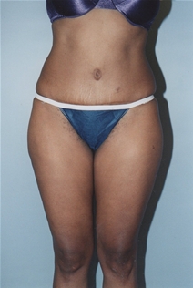Tummy Tuck After Photo by Kristoffer Ning Chang, MD; San Francisco, CA - Case 20537