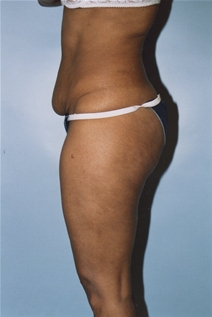 Tummy Tuck Before Photo by Kristoffer Ning Chang, MD; San Francisco, CA - Case 20537