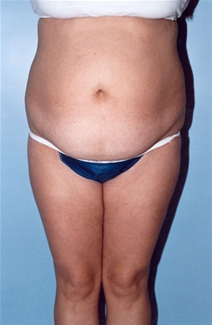 Tummy Tuck Before Photo by Kristoffer Ning Chang, MD; San Francisco, CA - Case 20538