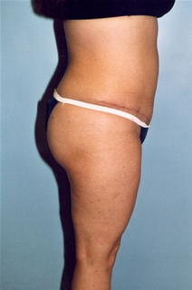 Tummy Tuck After Photo by Kristoffer Ning Chang, MD; San Francisco, CA - Case 20538