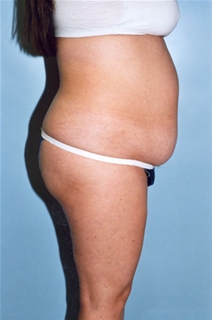 Tummy Tuck Before Photo by Kristoffer Ning Chang, MD; San Francisco, CA - Case 20538