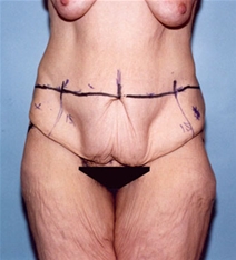 Tummy Tuck Before Photo by Kristoffer Ning Chang, MD; San Francisco, CA - Case 20539