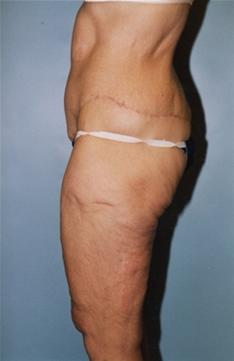 Tummy Tuck After Photo by Kristoffer Ning Chang, MD; San Francisco, CA - Case 20539