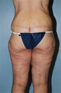 Tummy Tuck After Photo by Kristoffer Ning Chang, MD; San Francisco, CA - Case 20539