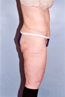 Body Contouring After Photo by Kristoffer Ning Chang, MD; San Francisco, CA - Case 20544