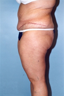 Body Contouring After Photo by Kristoffer Ning Chang, MD; San Francisco, CA - Case 20545