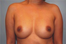 Breast Augmentation After Photo by Kristoffer Ning Chang, MD; San Francisco, CA - Case 23086