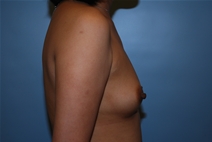 Breast Augmentation Before Photo by Kristoffer Ning Chang, MD; San Francisco, CA - Case 23086