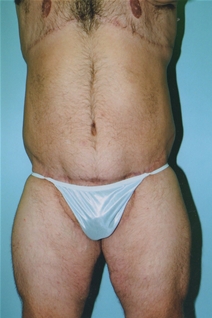 Body Contouring After Photo by Kristoffer Ning Chang, MD; San Francisco, CA - Case 23087