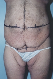 Body Contouring Before Photo by Kristoffer Ning Chang, MD; San Francisco, CA - Case 23087