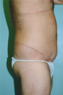 Body Contouring After Photo by Kristoffer Ning Chang, MD; San Francisco, CA - Case 23087