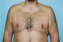 Male Breast Reduction After Photo by Kristoffer Ning Chang, MD; San Francisco, CA - Case 23088