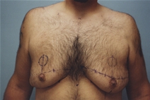 Male Breast Reduction Before Photo by Kristoffer Ning Chang, MD; San Francisco, CA - Case 23088
