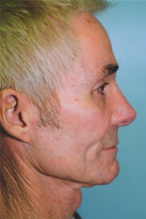Rhinoplasty After Photo by Kristoffer Ning Chang, MD; San Francisco, CA - Case 23089