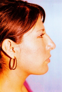 Rhinoplasty After Photo by Kristoffer Ning Chang, MD; San Francisco, CA - Case 23090