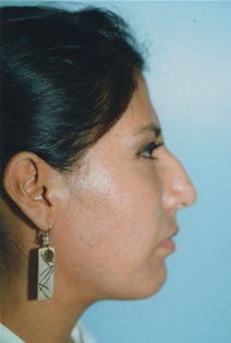 Rhinoplasty Before Photo by Kristoffer Ning Chang, MD; San Francisco, CA - Case 23090