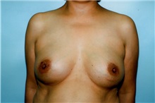Breast Augmentation After Photo by Kristoffer Ning Chang, MD; San Francisco, CA - Case 23147