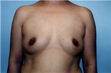 Breast Augmentation Before Photo by Kristoffer Ning Chang, MD; San Francisco, CA - Case 23147