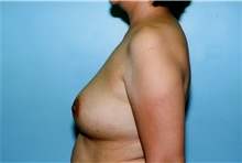 Breast Augmentation After Photo by Kristoffer Ning Chang, MD; San Francisco, CA - Case 23147