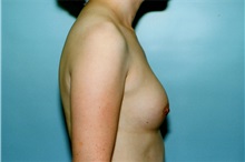 Breast Augmentation After Photo by Kristoffer Ning Chang, MD; San Francisco, CA - Case 23164